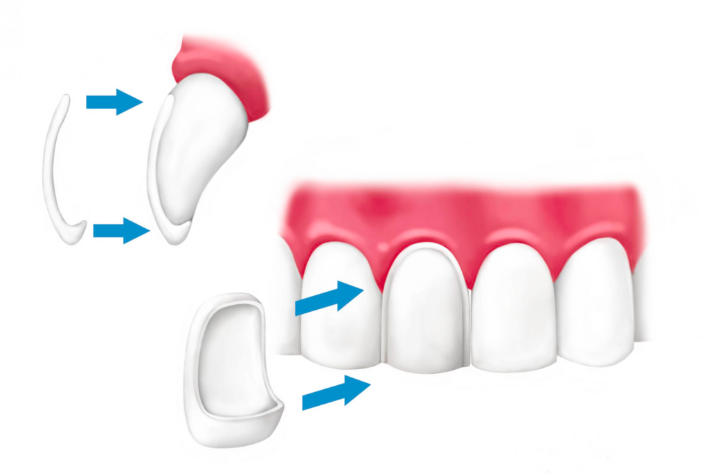 protetyka stomatologiczna licówka stomatologiczna