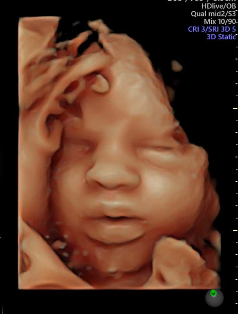 USG 3D/4D Rumia Trójmiasto twarz dziecka